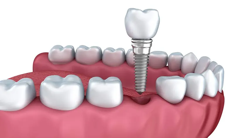 A dental implant shown in the jawbone beside natural teeth.